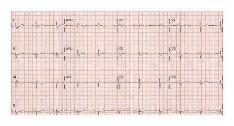 borderline ecg|borderline ecg afwijking.